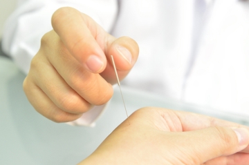 acupuncture