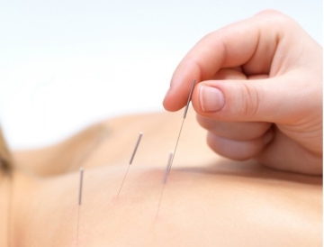 acupuncture