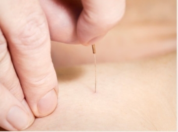 acupuncture